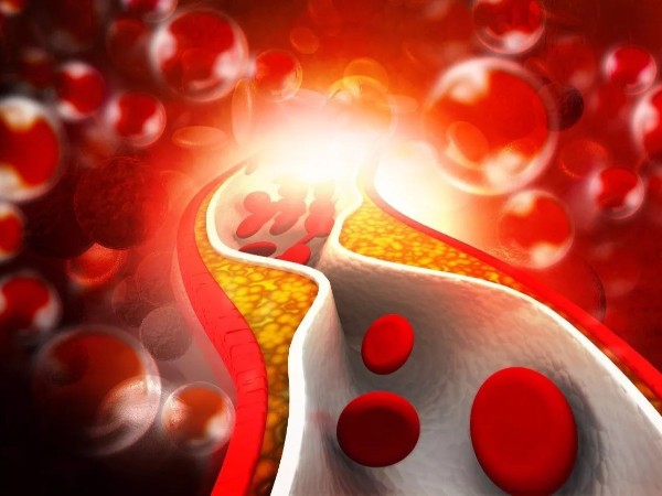 冬天心腦血管頻發，一定要避免血管堵塞