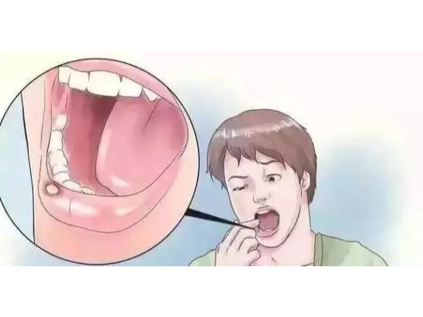 口腔潰瘍反反復復，補充維C就能好？